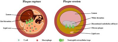 Plaque Erosion: A Distinctive Pathological Mechanism of Acute Coronary Syndrome